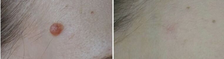 before and after laser papilloma removal photo 2