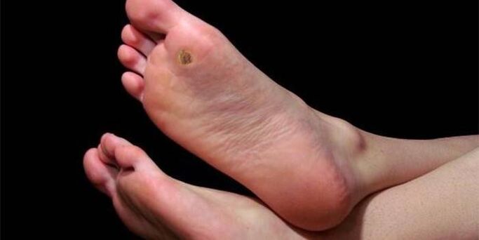 Plantar wart (toe) on the foot