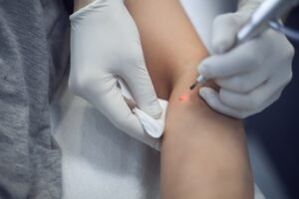 Laser treatment