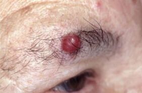 Papilloma on the eyebrows