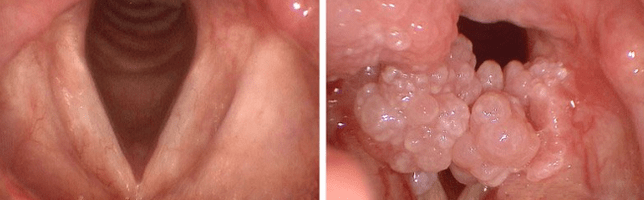 Papillomes in the mouth