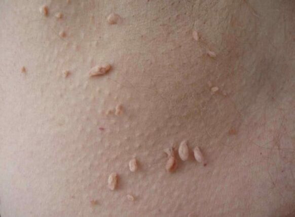 Accrochords on the skin