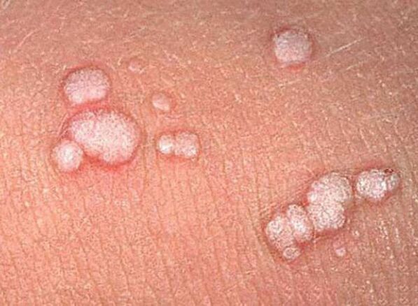 Papillomes on the human body