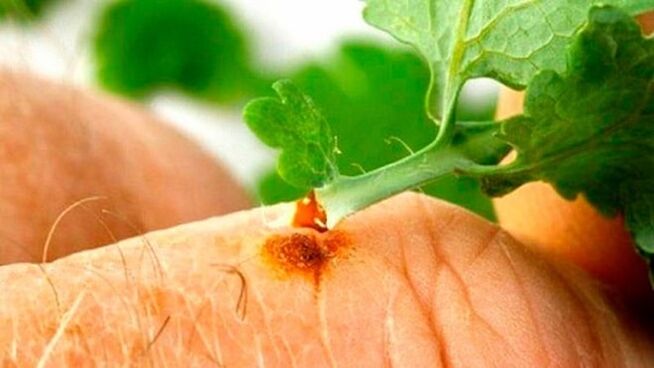 Application of celandine juice on a wart