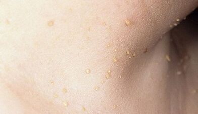 risk of developing papillomatosis on the neck