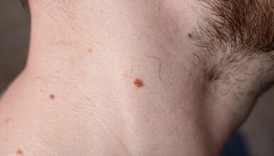 why papillomas appear on the neck