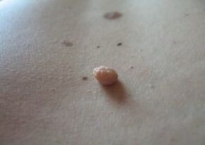 Papilloma is a growth on the surface of the skin
