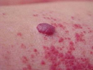 Red spots around the papilloma