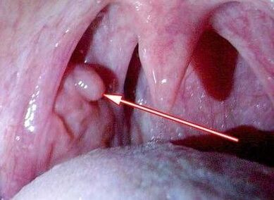 Throat papilloma