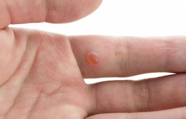 Vulgar wart on the finger