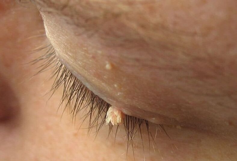 filamentous wart on the eyelid