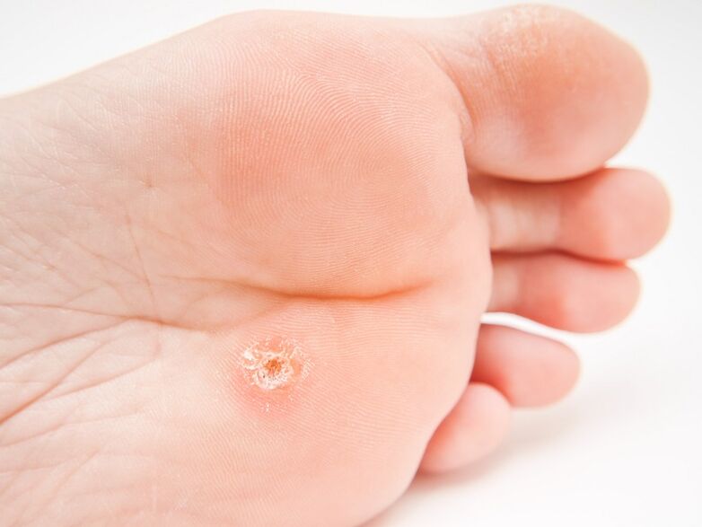 plantar wart on the foot