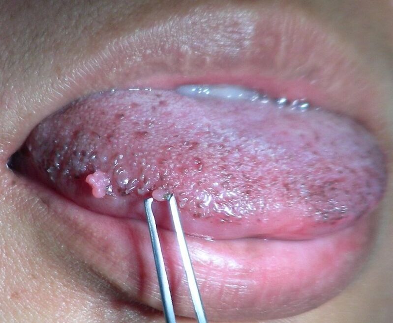 warts on the tongue
