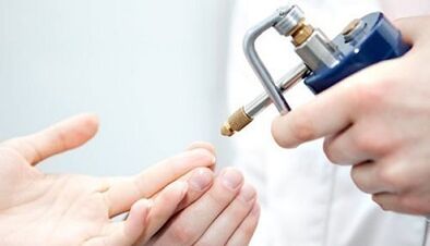 Criodestraction as a method for the treatment of warts