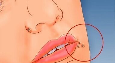 The reasons for the apparition of warts